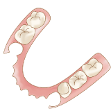 ノンクラスプデンチャーのイラスト